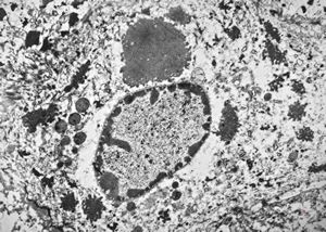 F, 11y. | ichthyosis hystrix type Curth-Macklin F, 11y. | ichthyosis hystrix type Curth-Macklin